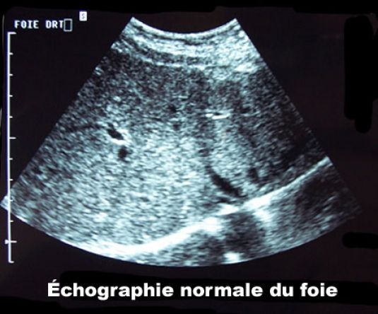 foie-echographie-normale.jpg